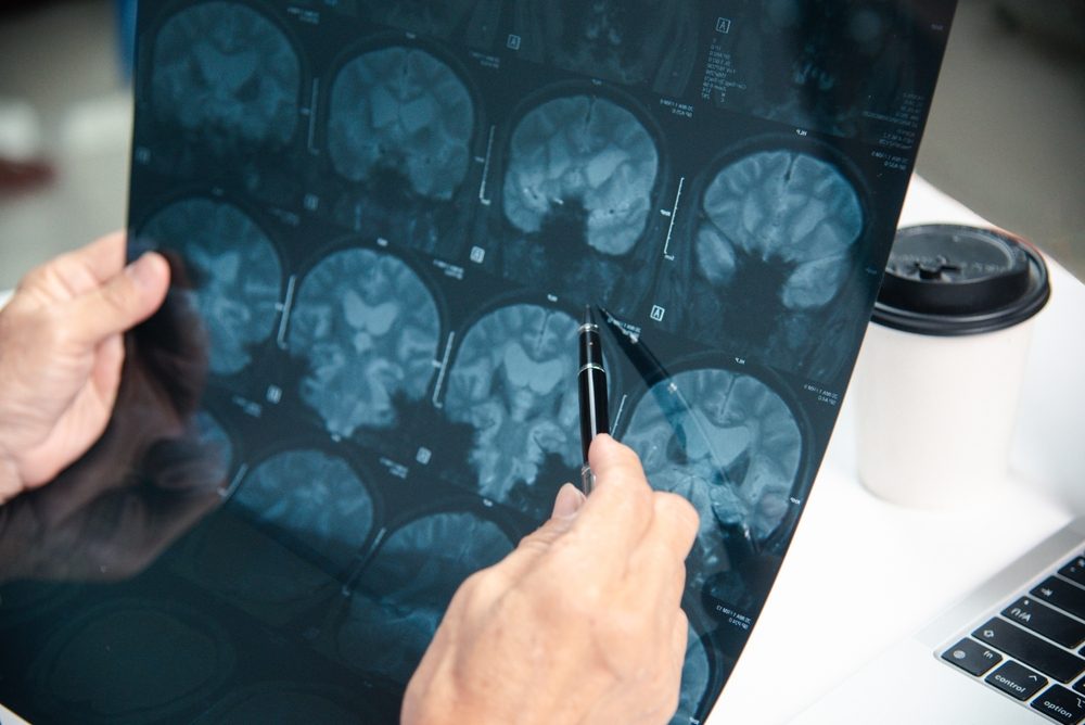 What Is an Anoxic Brain Injury?